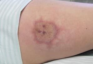 Δήγμα αράχνης - Image 3